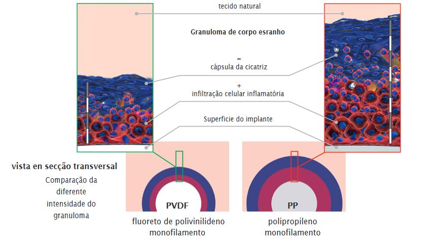 Menor formação de corpos estranhos com os implantes dynamesh vendidos pela cardiolink pt